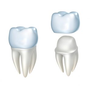 How sensitive should I be after getting dental crowns in Richardson?